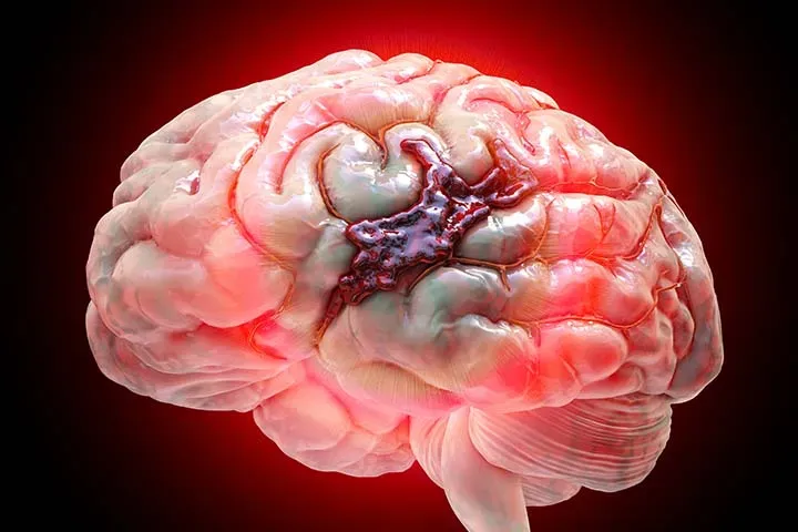 Brain Hemorrhage
