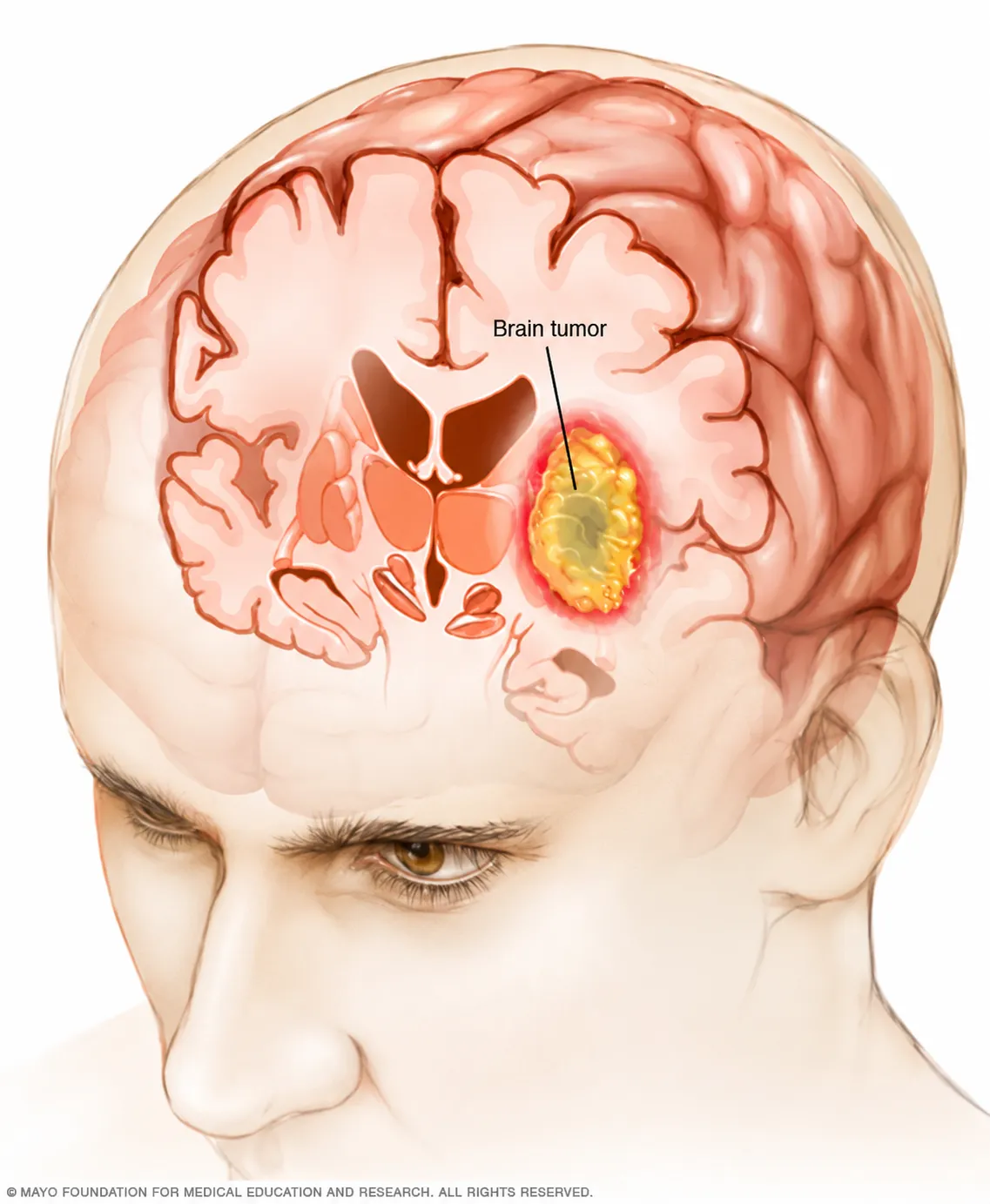 Brain Tumor Surgery