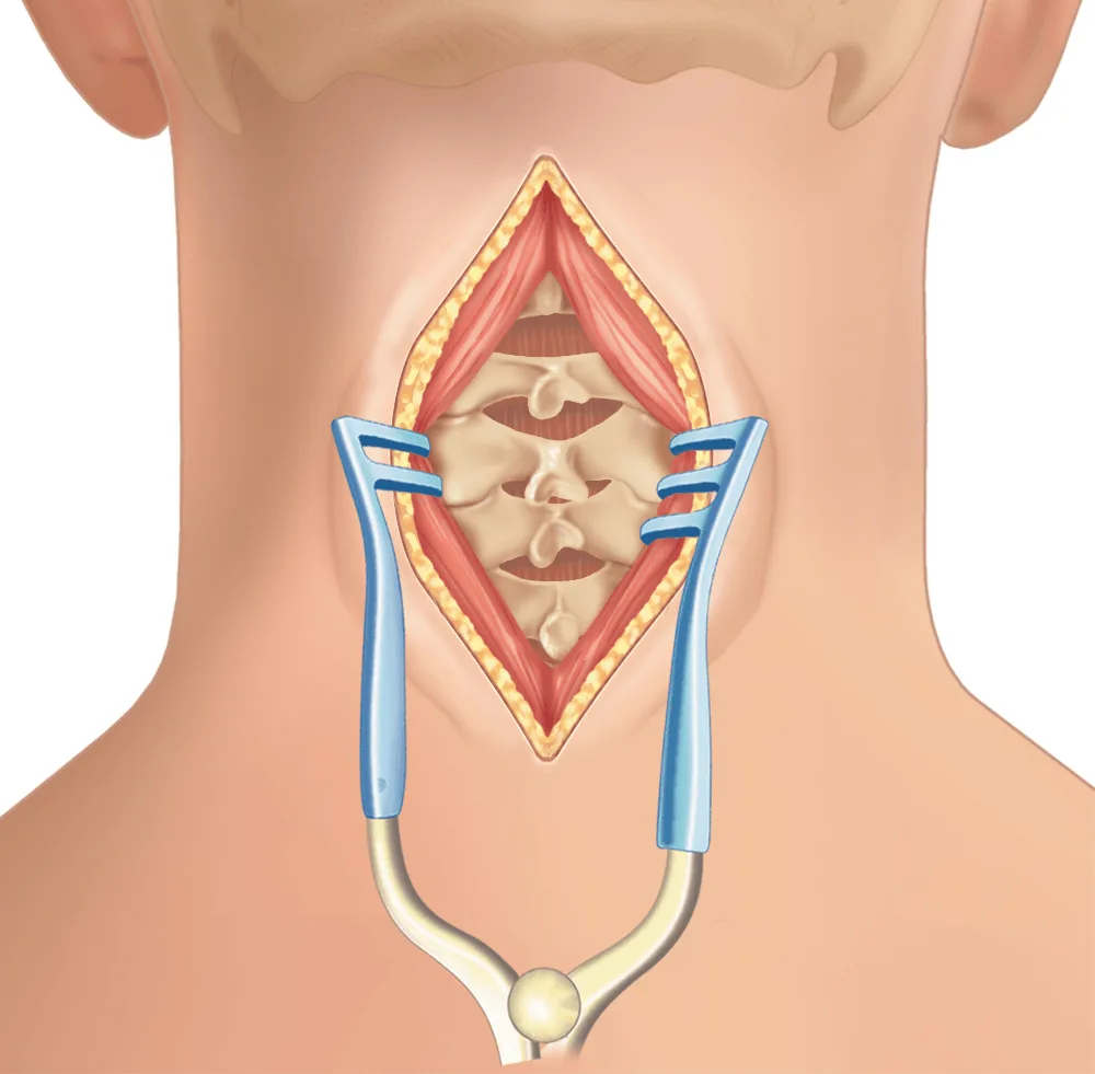 Cervical Disc Surgery