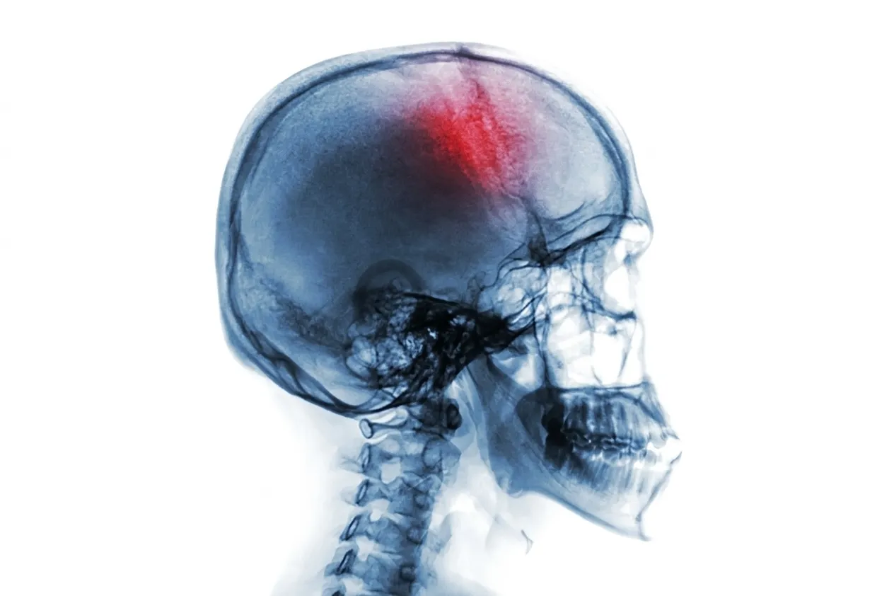 Head Injury